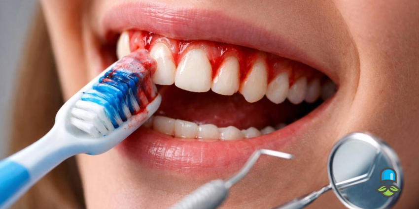چرا هنگام مسواک زدن لثه خونریزی میکند؟